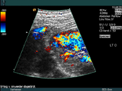 left kidney not affected by afbn (acute focal bacterial nephritis)